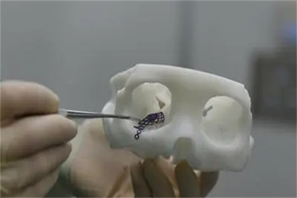 眼部整形3D打印技术