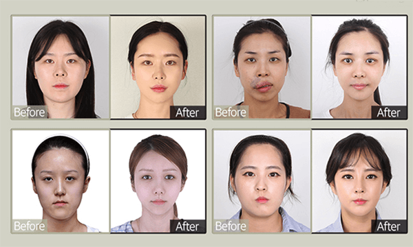 韩国Faceline菲斯莱茵整形外科医院双鄂手术真人对比图