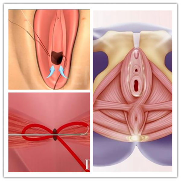 女性缩紧术的治疗方式：推荐3D生物束带紧缩术更持久