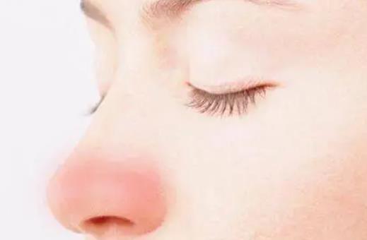 酒渣鼻有哪些治疗方法？酒渣鼻后如何护理?
