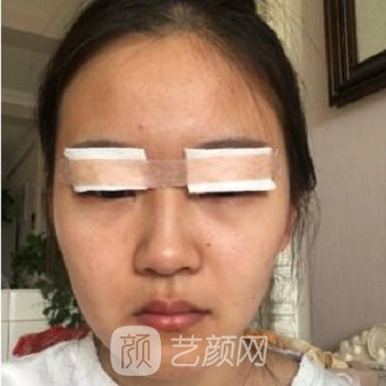 王海南双眼皮修复怎么样？医生简介+双眼皮修复案例
