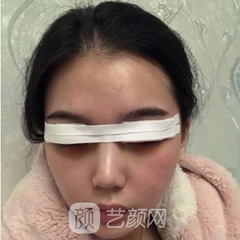 刘洁双眼皮风格展示，真人双眼皮恢复全过程一览