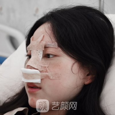 上海原辰整形医院隆鼻案例出炉｜内附亲身体验案例