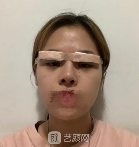 重庆西南整形医院双眼皮手术失败案例，重获自信