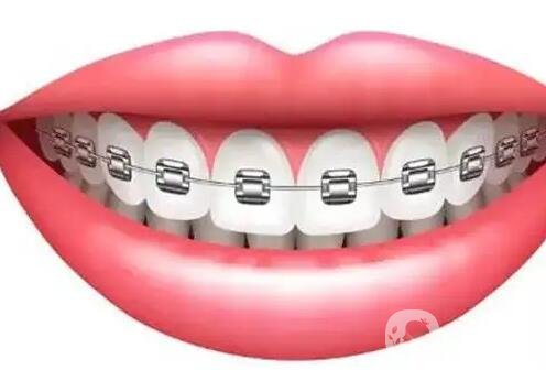 矫正牙齿选什么托槽?金属自锁托槽特点有哪些?优点是什么?