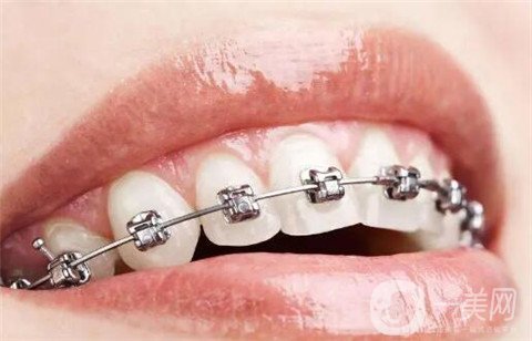 审美牙齿矫正的具体表现在什么地方?