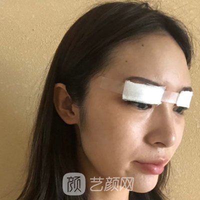 西安慕生枝医生做双眼皮怎么样？2022招牌案例上线