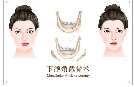 广东珠江医院下颌角整形效果图，手术过程记录及术后效果展现~