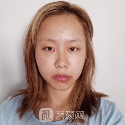 重庆唐婷医生双眼皮案例公开|90天恢复细节分享