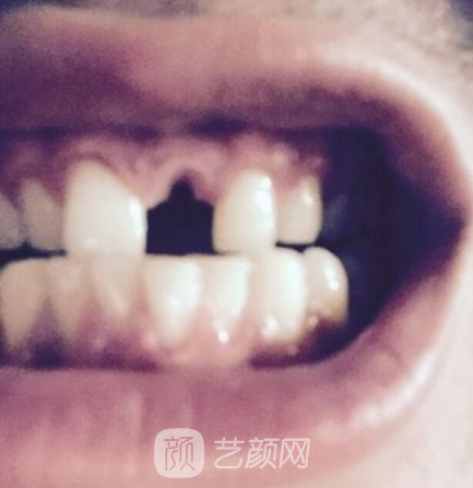 西安海涛口腔医院种植牙怎么样？2022招牌案例出炉