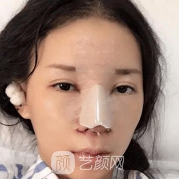 成都李萍隆鼻案例，俏皮少女风的鼻部形态，爱极了