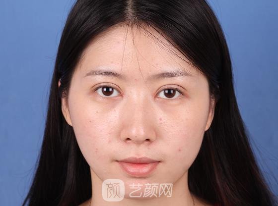昆明美立方刘凤斌双眼皮修复案例曝光|附体验对比图