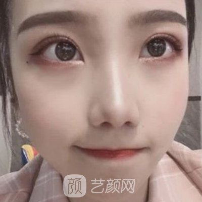 深圳容术医疗美容门诊部正规吗？2022双眼皮案例曝光