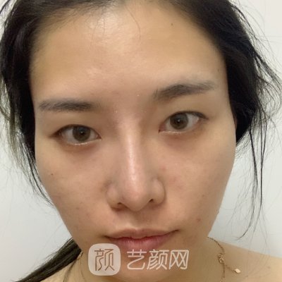 石家庄天宏医疗美容医院双眼皮案例发布|附体验效果图