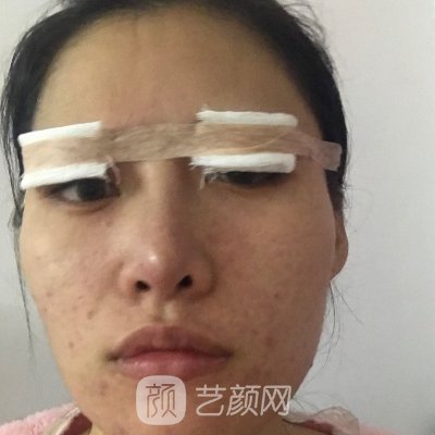 石家庄天宏医疗美容医院双眼皮案例发布|附体验效果图