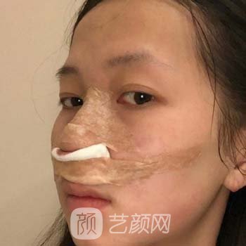 廖连平做的鼻子案例，术后三个月恢复很不错，给医生打call