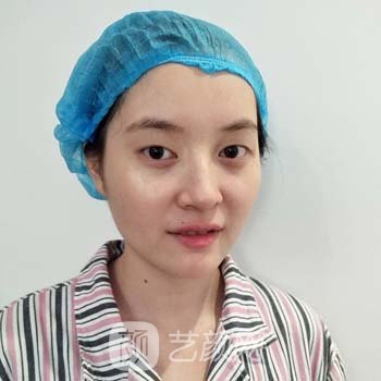 成都李萍双眼皮修复案例，真人记录手术过程以及术后效果