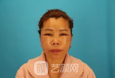北京八大处张妍拉皮除皱美容案例，医生个人简介恢复过程图片