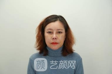 北京八大处张妍拉皮除皱美容案例，医生个人简介恢复过程图片