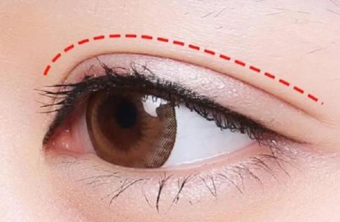 做双眼皮需要多长时间恢复？