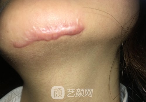 上海虹桥医院整形科疤痕修复案例公开｜附体验效果图