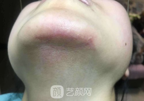 上海虹桥医院整形科疤痕修复案例公开｜附体验效果图