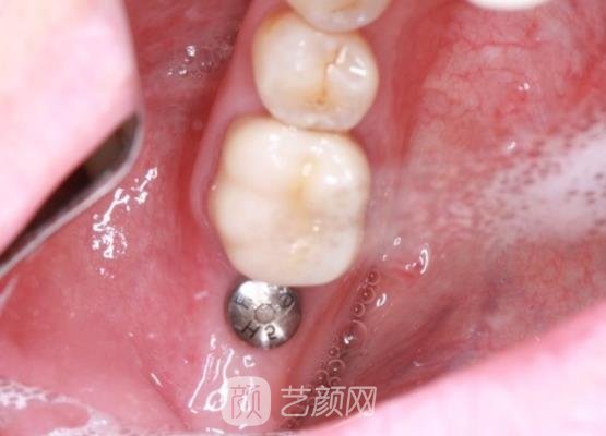 杭州萧山希美口腔门诊部种植牙案例一览|附体验对比图