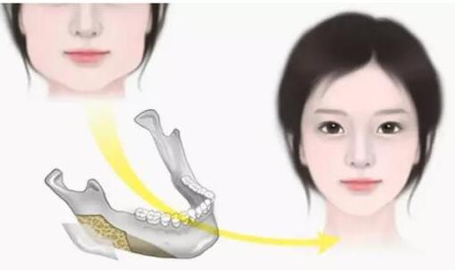 江西省妇幼保健院下颌角整形效果图展示，手术过程及真实效果展露无疑！