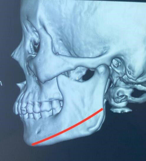 济宁医学院附属医院下颌角整形效果图展示，真人记录手术过程及术后效果~