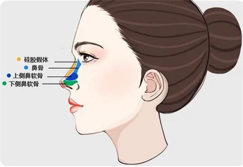 有哪些影响耳软骨垫鼻尖维持时间的因素？