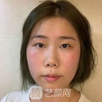 刘旺医生双眼皮整形案例，手术风格详细展现