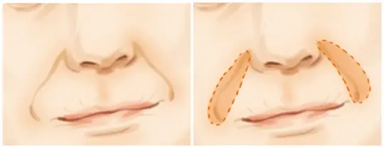 自体脂肪填充鼻唇沟有哪些优势？