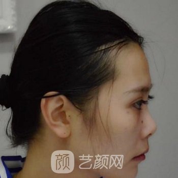 北京郭树忠隆鼻案例，鼻子的变化让我重获自信