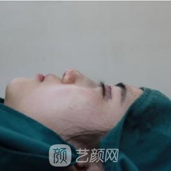 北京八大处王欢隆鼻案例，鼻子立体了，容貌也变得惊艳