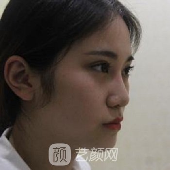 北京八大处王欢隆鼻案例，鼻子立体了，容貌也变得惊艳