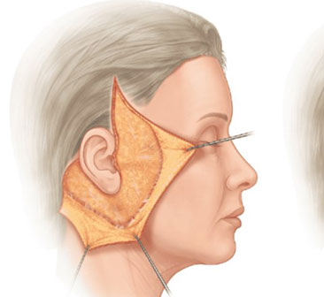 北京加减美V6拉皮技术有什么优势？黄寅守面部提升怎么样？