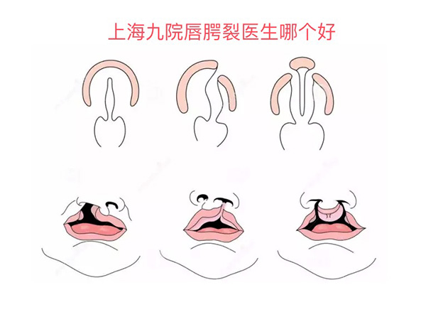 上海九院唇腭裂专科医生排名