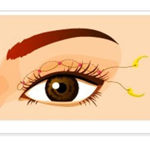 做双眼皮多少钱？分析下双眼皮手术的方法和类型以供参考