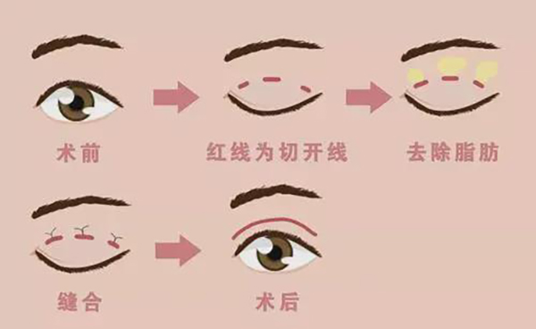 双眼皮手术的方法和类型