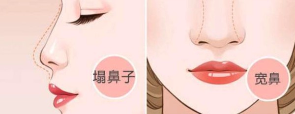 肋骨鼻和耳软骨鼻哪个好?