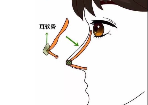 肋骨鼻和耳软骨鼻哪个好?
