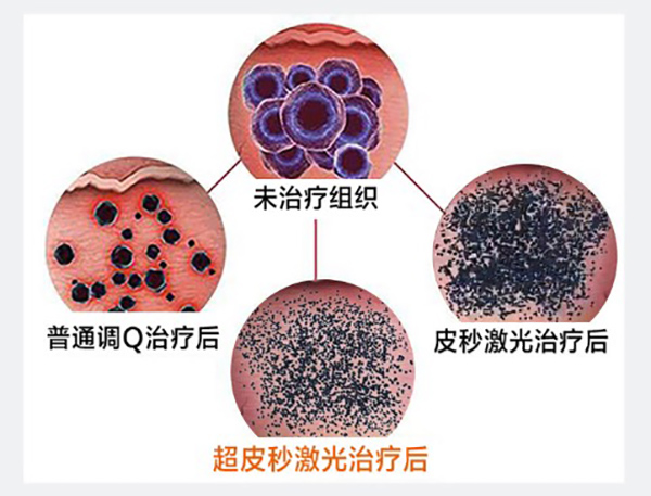 皮肤科在线医生免费咨询,超皮秒激光祛斑会反黑吗?