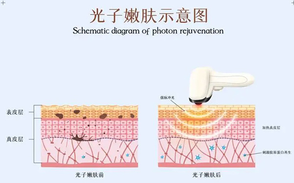皮肤病免费问诊24小时在线回答,光子嫩肤能解决哪些面部问题