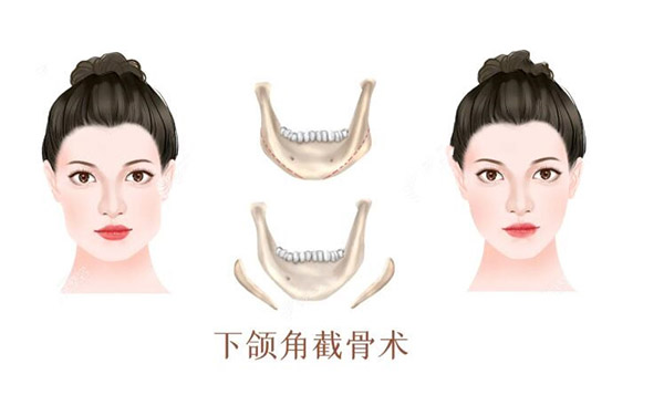 下颌角磨骨