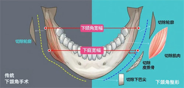 下颌角截骨