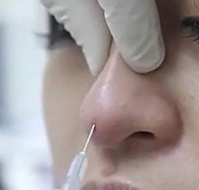 关于鼻基底填充,你应该知道的事!三甲医师科普这4个关键问题