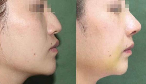 鼻基底填充是什么