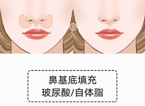 鼻基底填充是什么
