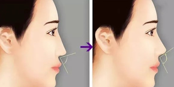 鼻基底填充是什么