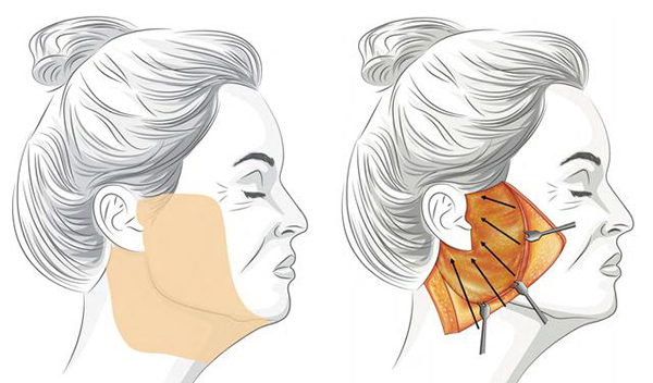 上海九人民医院拉皮整形哪个医生好